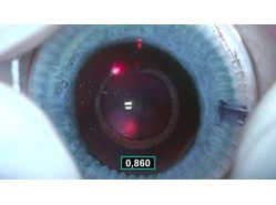 CAPULaser