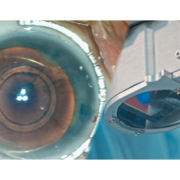 ESCRS CAPSULASER Dr Pavel Stodulka Presents @ Near Live Surgery Programme,